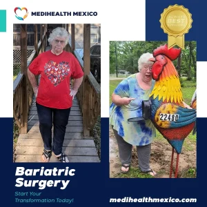 Bariatric Procedure Before and After, MediHealth Mexico