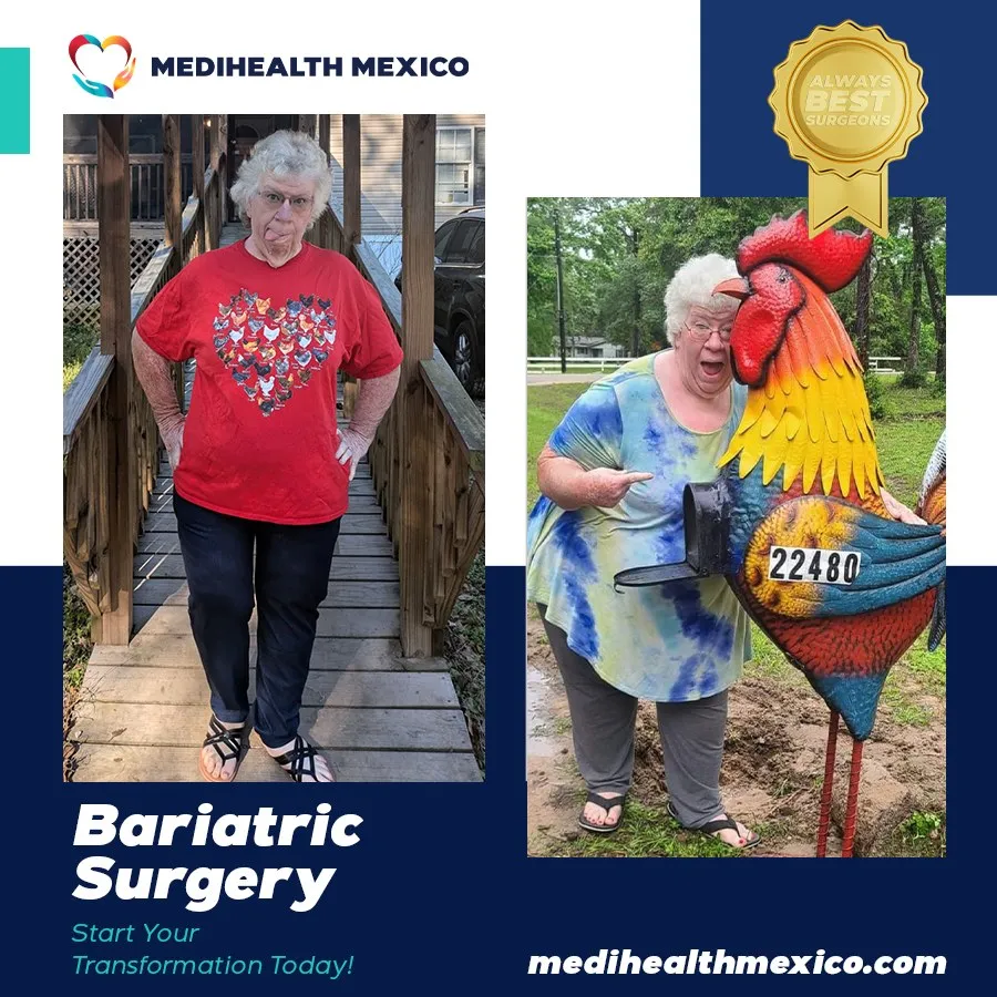 Bariatric Procedure Before and After, MediHealth Mexico