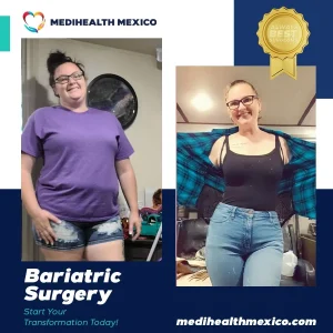 Bariatric Procedure Before and After, MediHealth Mexico