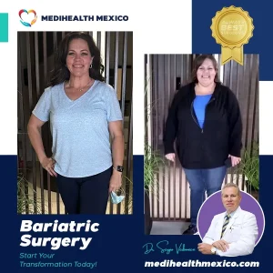 Bariatric Procedure Before and After, MediHealth Mexico