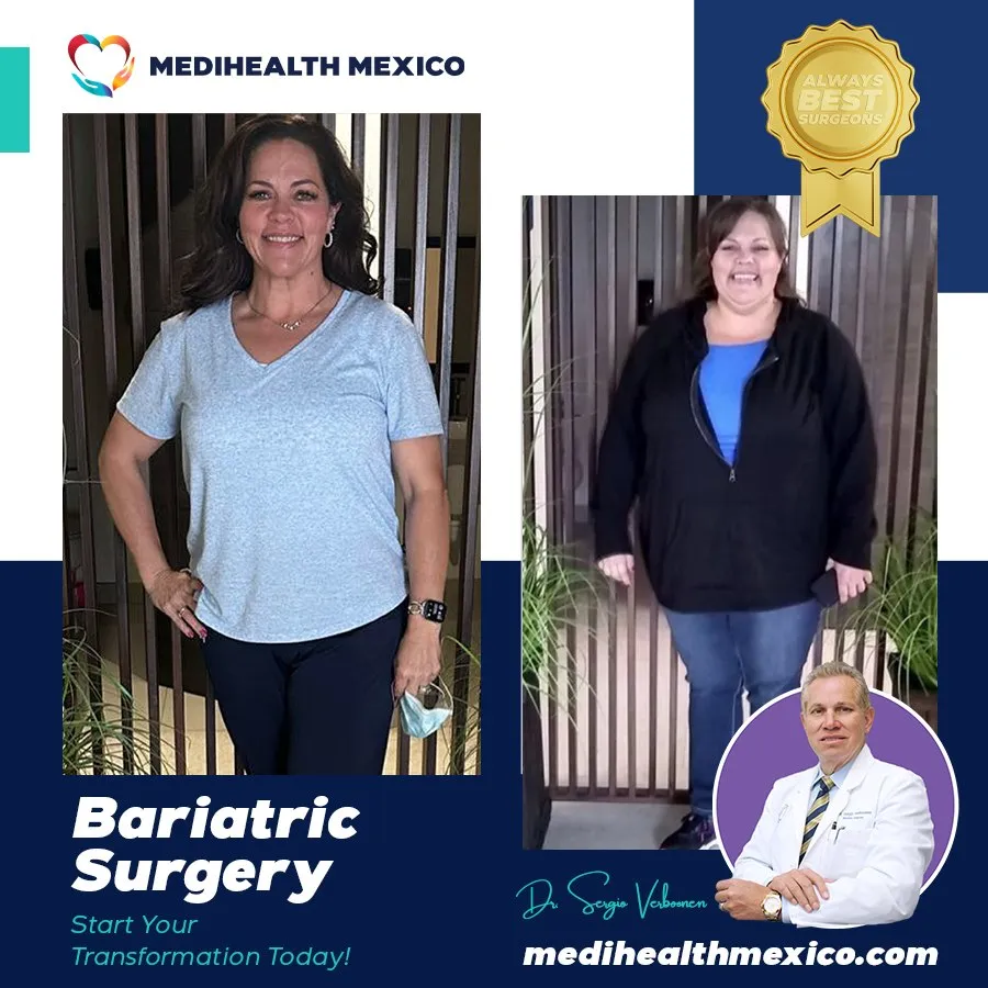 Bariatric Procedure Before and After, MediHealth Mexico