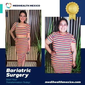 Bariatric Procedure Before and After, MediHealth Mexico