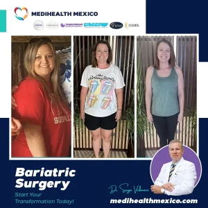 Bariatric Procedure Before and After, MediHealth Mexico
