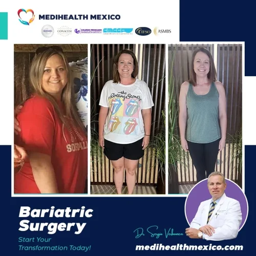 Bariatric Procedure Before and After, MediHealth Mexico