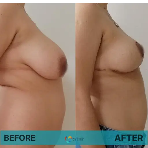 breast lift before and after medihealth mexico