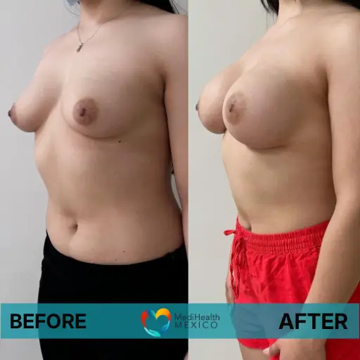 breast lift before and after medihealth mexico
