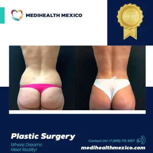Plastic Procedure Before and After, MediHealth Mexico