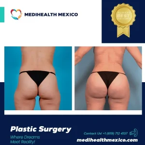 Plastic Procedure Before and After, MediHealth Mexico