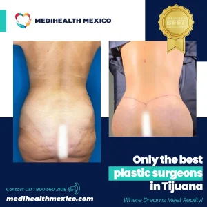 Plastic Procedure Before and After, MediHealth Mexico