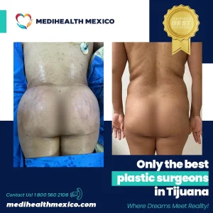 Plastic Procedure Before and After, MediHealth Mexico