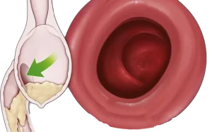 Tore Procedure 1
