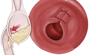 Tore Procedure 2