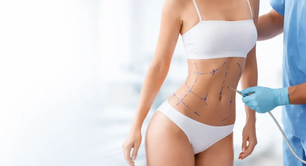 Liposuction Surgery Tijuana Mhm01