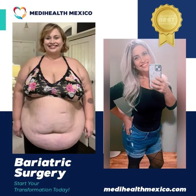 Bariatric Before And After00107