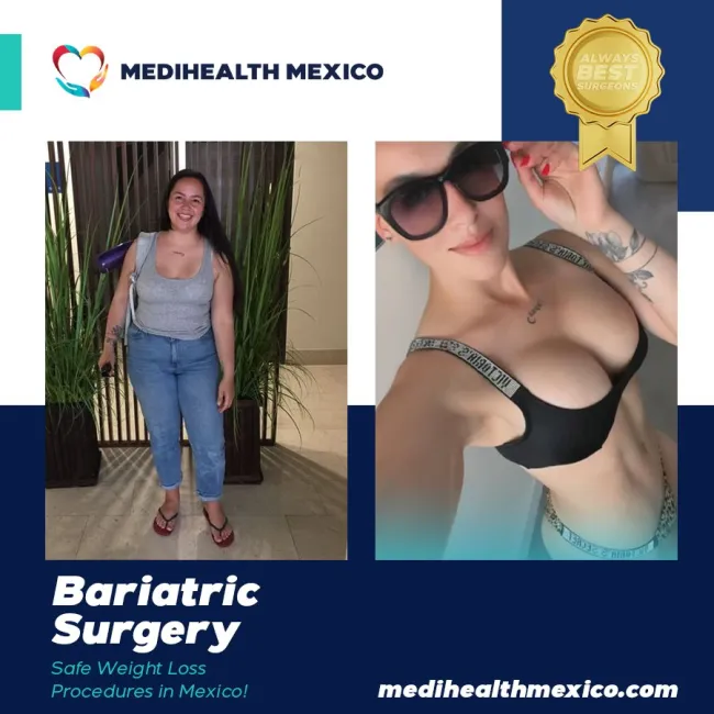 Bariatric Before And After00111