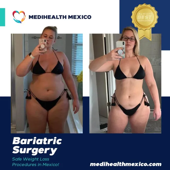Bariatric Before And After00112